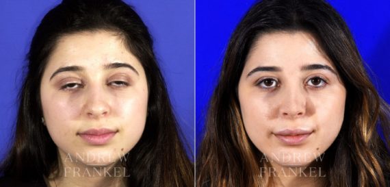 Rhinoplasty before and after photos in Beverly Hills, CA, Patient 6791