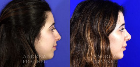 Rhinoplasty before and after photos in Beverly Hills, CA, Patient 6791