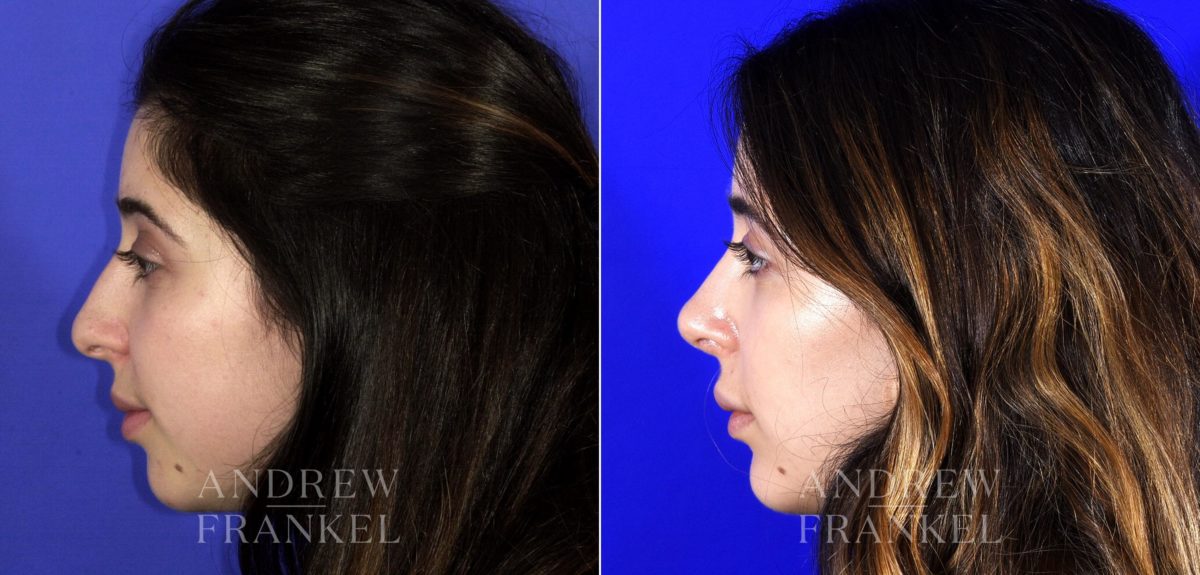 Rhinoplasty before and after photos in Beverly Hills, CA, Patient 6791