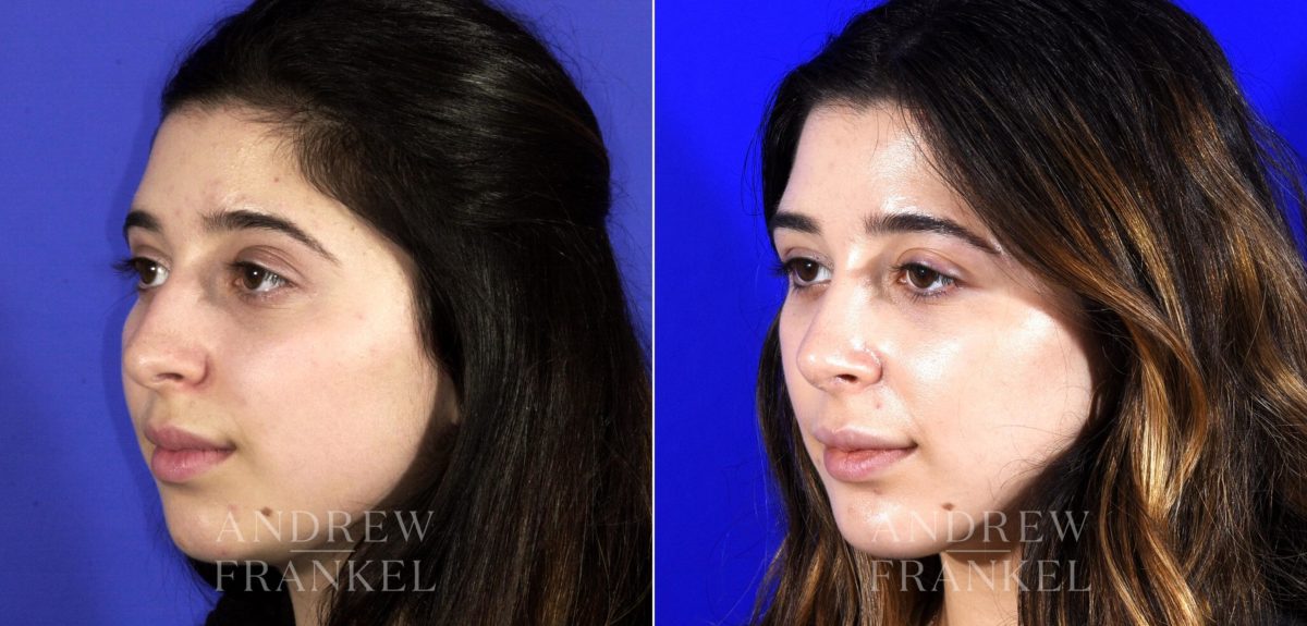 Rhinoplasty before and after photos in Beverly Hills, CA, Patient 6791