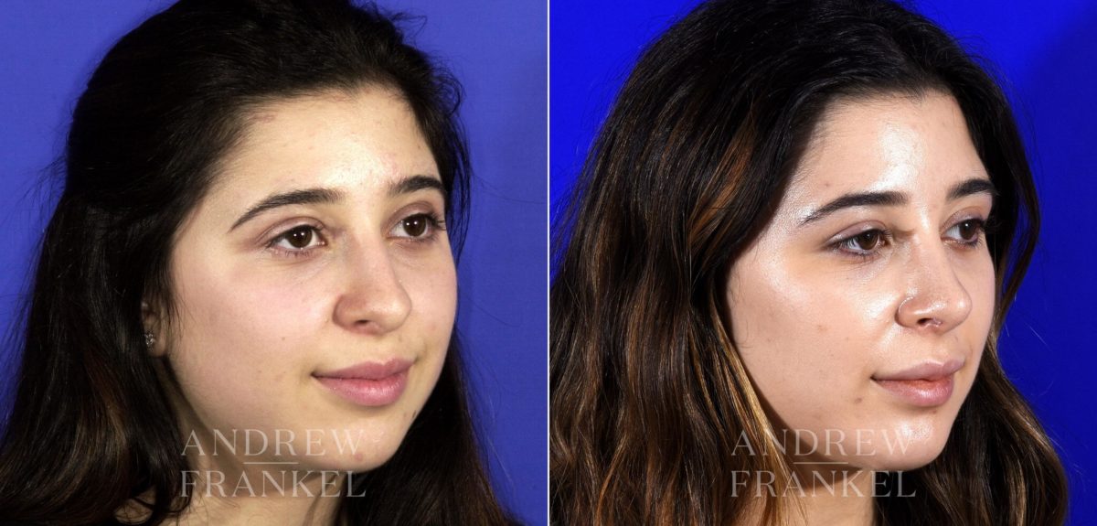 Rhinoplasty before and after photos in Beverly Hills, CA, Patient 6791