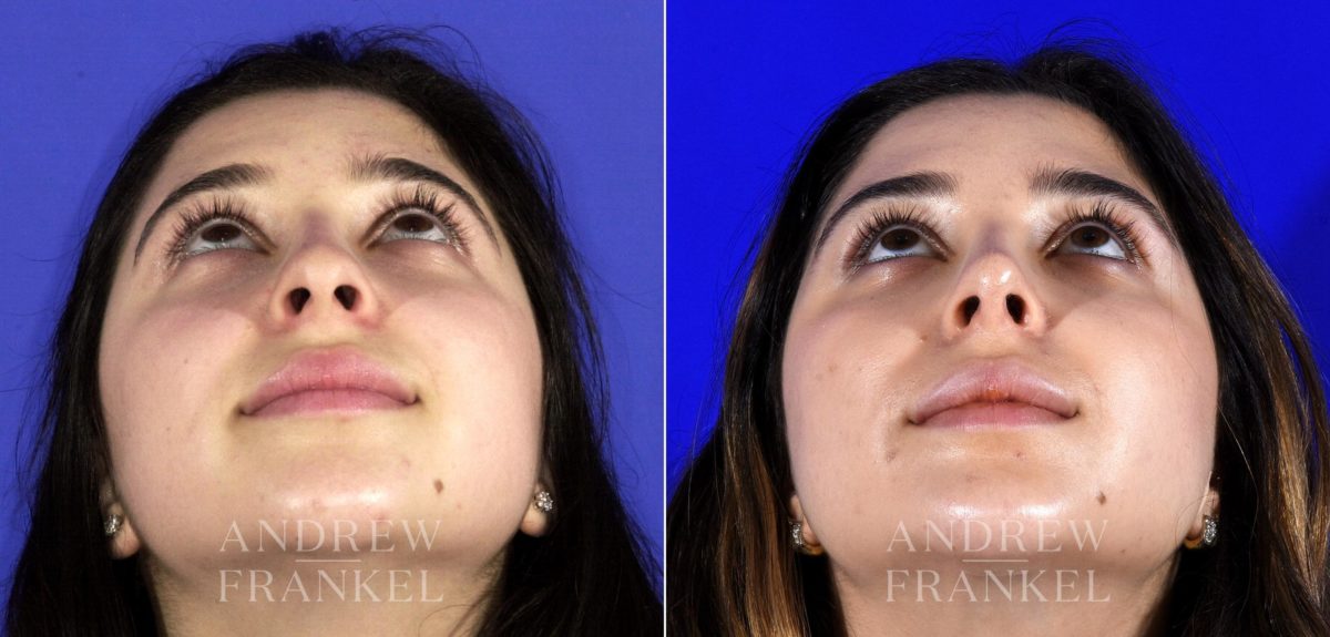 Rhinoplasty before and after photos in Beverly Hills, CA, Patient 6791