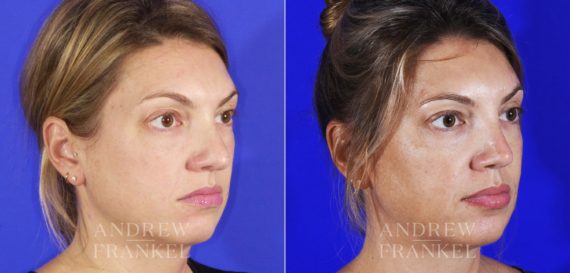 Revision Rhinoplasty before and after photos in Beverly Hills, CA, Patient 6834