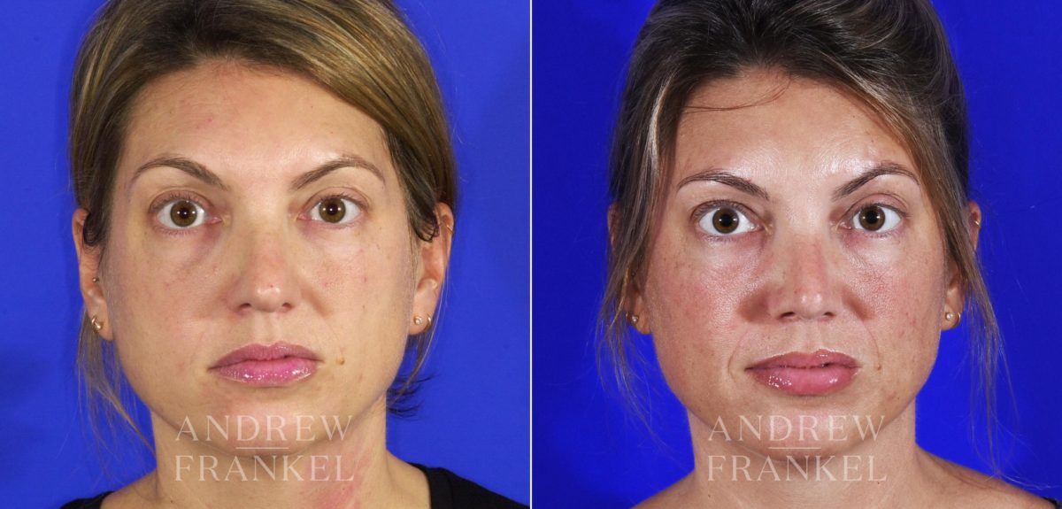 Revision Rhinoplasty before and after photos in Beverly Hills, CA, Patient 6834