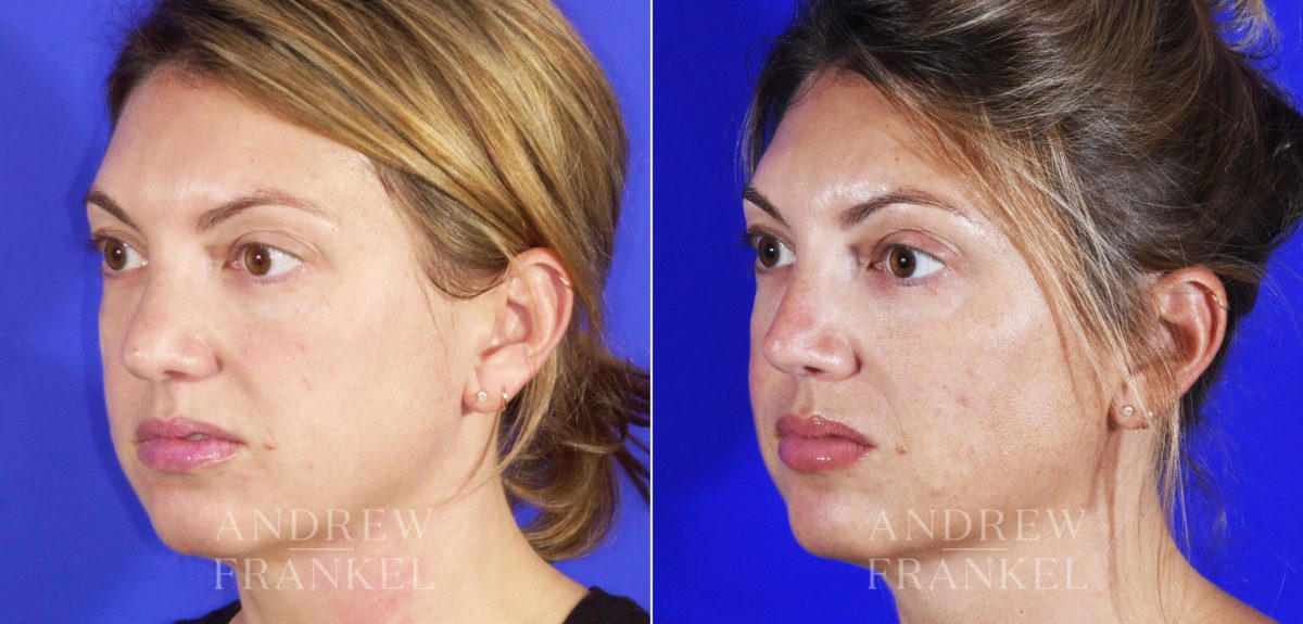 Revision Rhinoplasty before and after photos in Beverly Hills, CA, Patient 6834