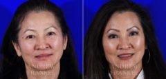 Brow Lift before and after photos in Beverly Hills, CA, Patient 6876