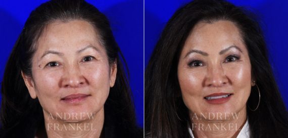 Brow Lift before and after photos in Beverly Hills, CA, Patient 6876