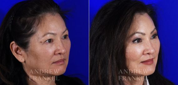 Brow Lift before and after photos in Beverly Hills, CA, Patient 6876