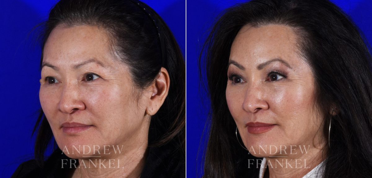 Brow Lift before and after photos in Beverly Hills, CA, Patient 6876