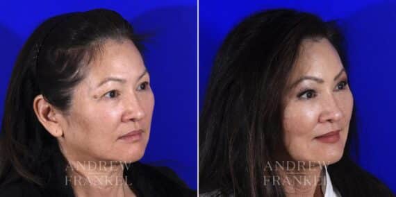 Blepharoplasty before and after photos in Beverly Hills, CA, Patient 6886