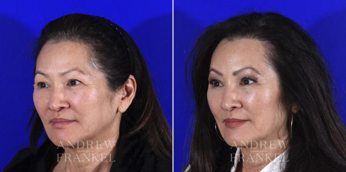 Blepharoplasty before and after photos in Beverly Hills, CA, Patient 6886