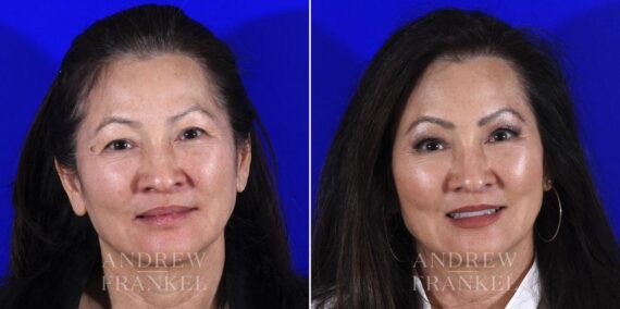 Blepharoplasty before and after photos in Beverly Hills, CA, Patient 6886