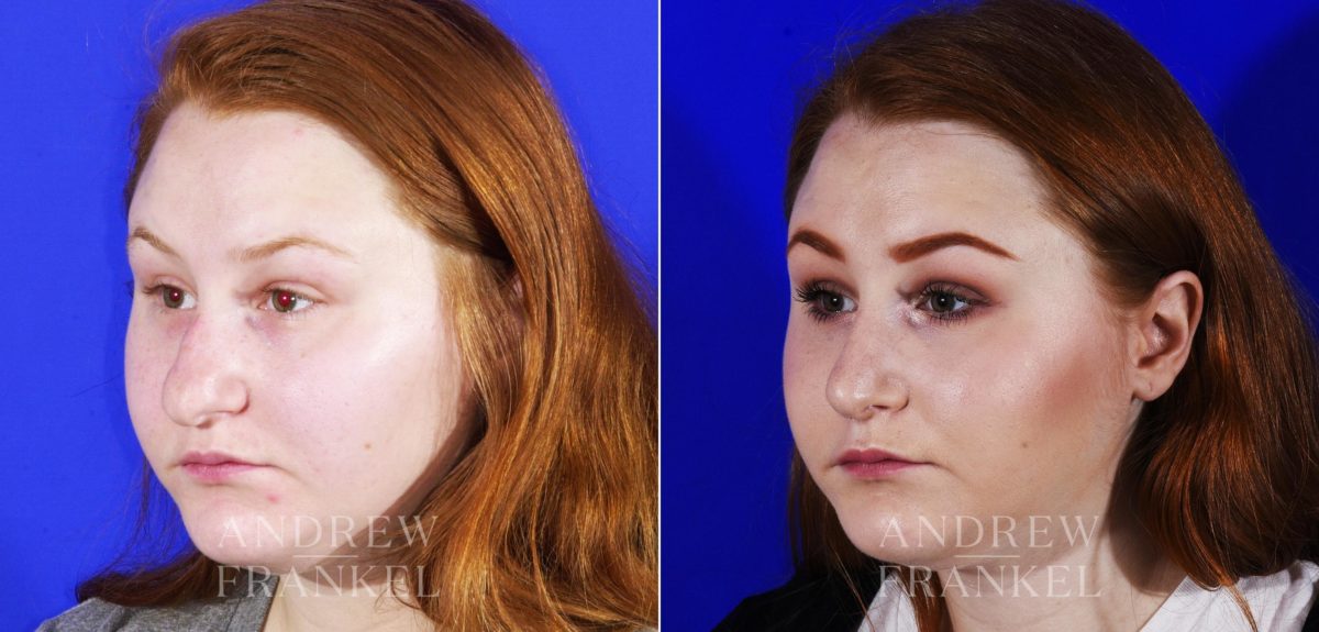 Rhinoplasty before and after photos in Beverly Hills, CA, Patient 6909
