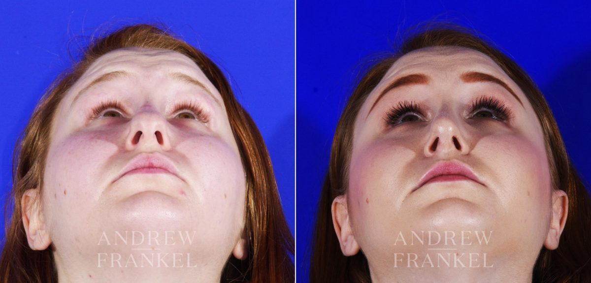 Rhinoplasty before and after photos in Beverly Hills, CA, Patient 6909