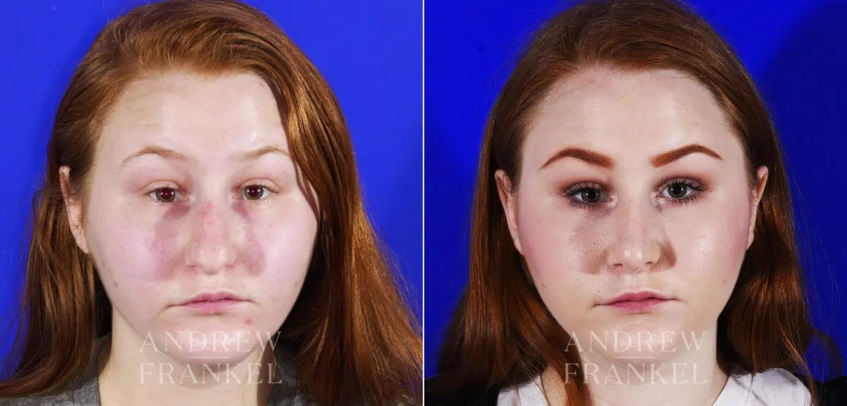 Rhinoplasty before and after photos in Beverly Hills, CA, Patient 6909