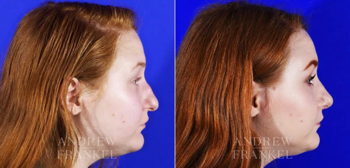 Rhinoplasty before and after photos in Beverly Hills, CA, Patient 6909