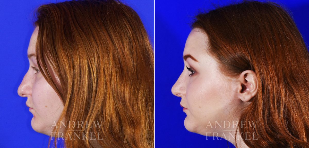Rhinoplasty before and after photos in Beverly Hills, CA, Patient 6909