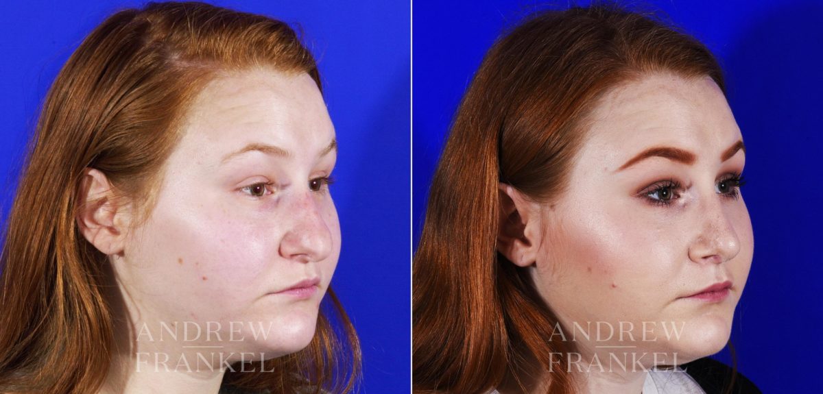 Rhinoplasty before and after photos in Beverly Hills, CA, Patient 6909