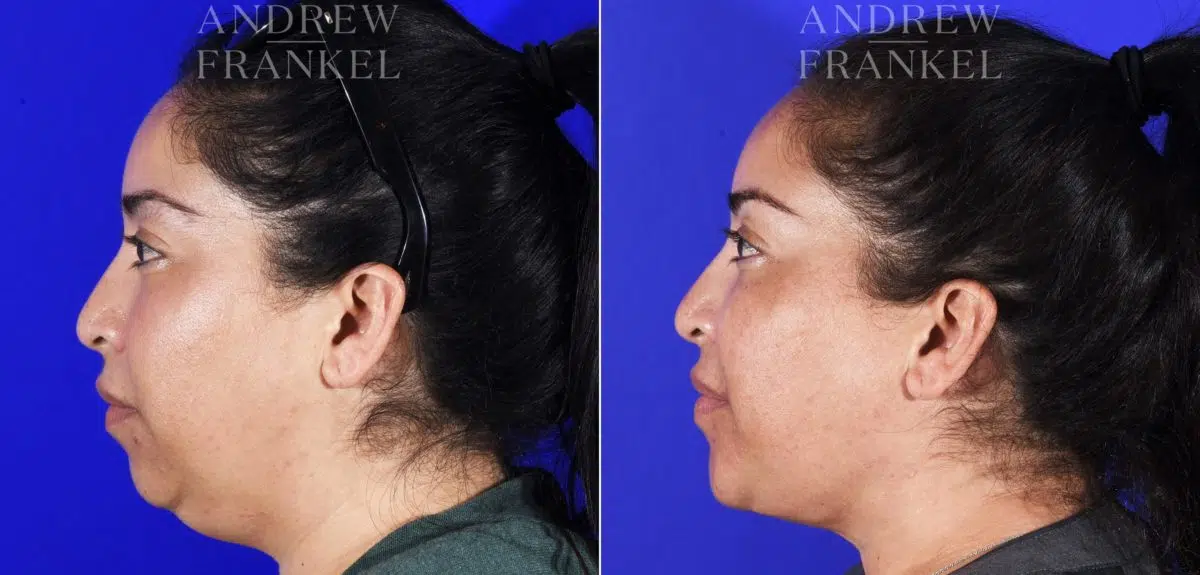 Neck Lift before and after photos in Beverly Hills, CA, Patient 6993