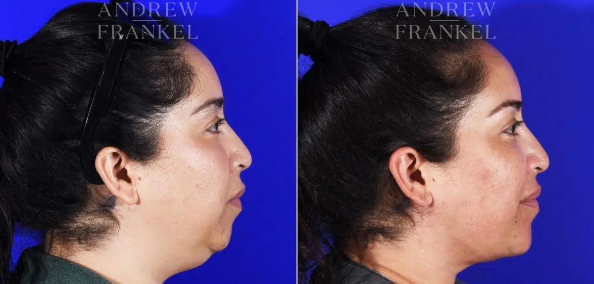 Neck Lift before and after photos in Beverly Hills, CA, Patient 6993