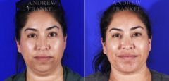 Neck Lift before and after photos in Beverly Hills, CA, Patient 6993