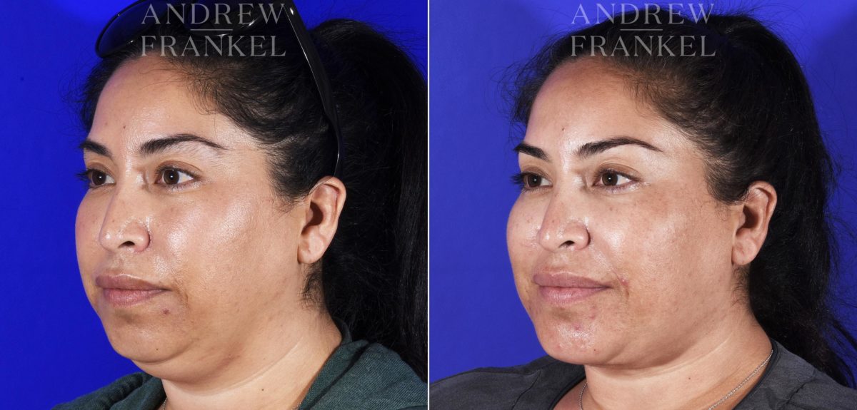 Neck Lift before and after photos in Beverly Hills, CA, Patient 6993