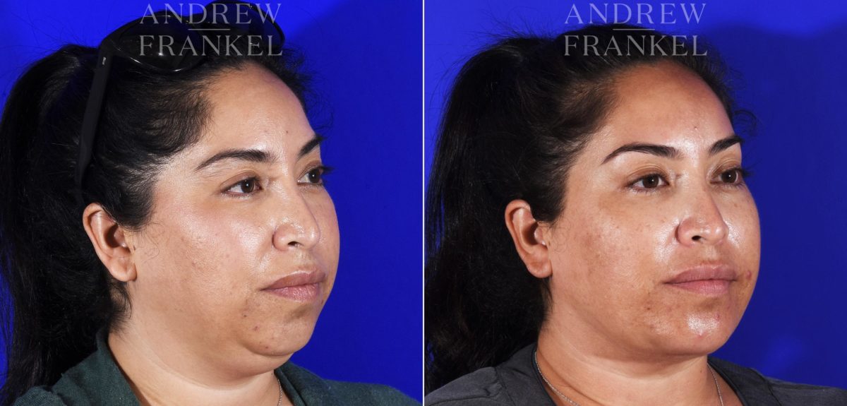 Neck Lift before and after photos in Beverly Hills, CA, Patient 6993