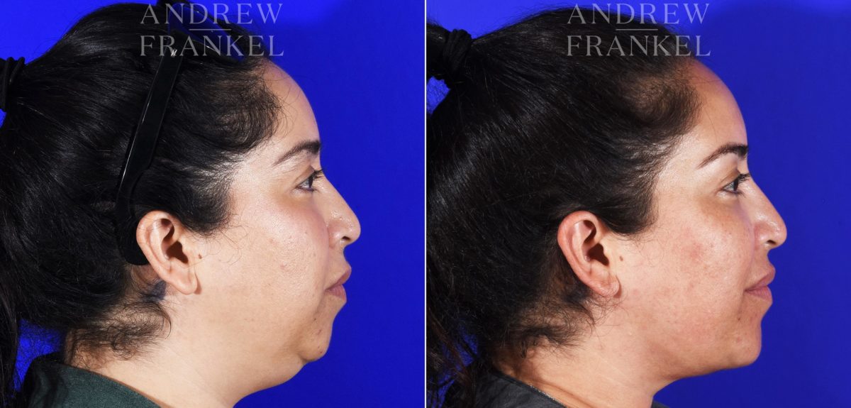 Jawline Contouring before and after photos in Beverly Hills, CA, Patient 7026