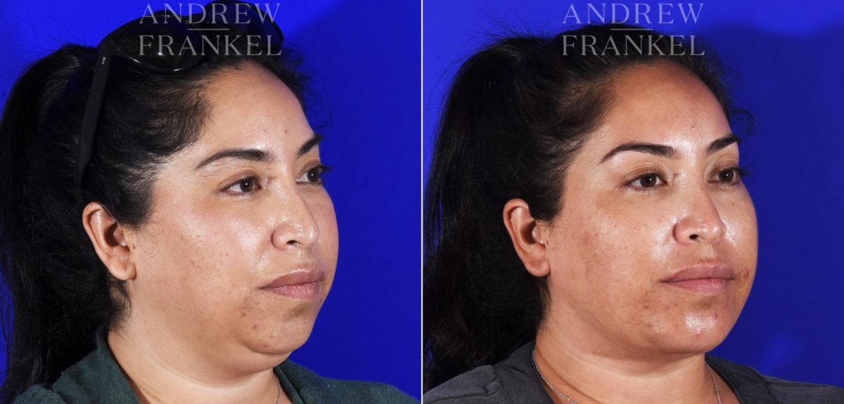 Jawline Contouring before and after photos in Beverly Hills, CA, Patient 7026
