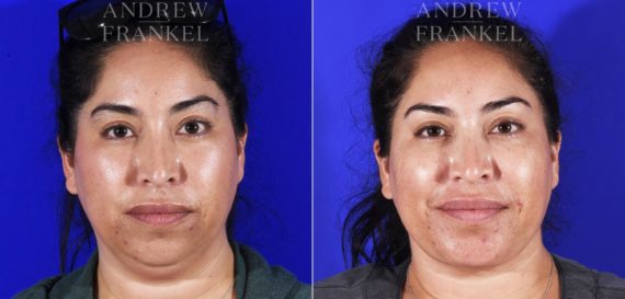 Jawline Contouring before and after photos in Beverly Hills, CA, Patient 7026