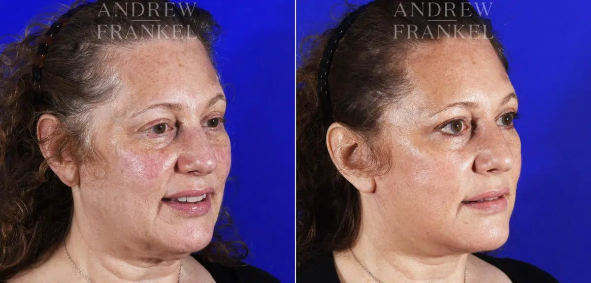 Facelift before and after photos in Beverly Hills, CA, Patient 7045