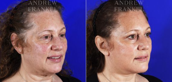 Facelift before and after photos in Beverly Hills, CA, Patient 7045