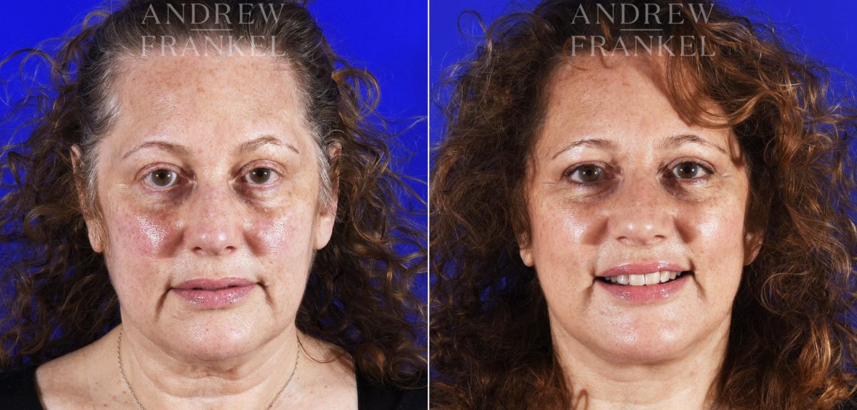 Facelift before and after photos in Beverly Hills, CA, Patient 7045