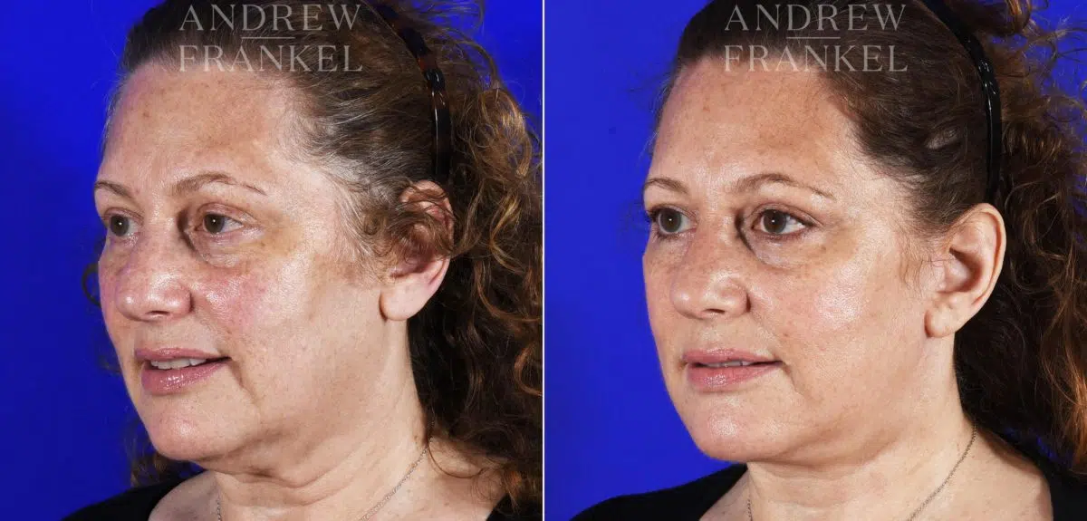 Facelift before and after photos in Beverly Hills, CA, Patient 7045