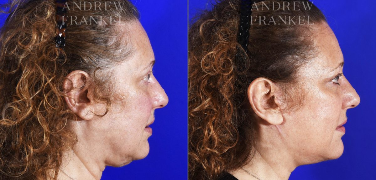 Facelift before and after photos in Beverly Hills, CA, Patient 7045