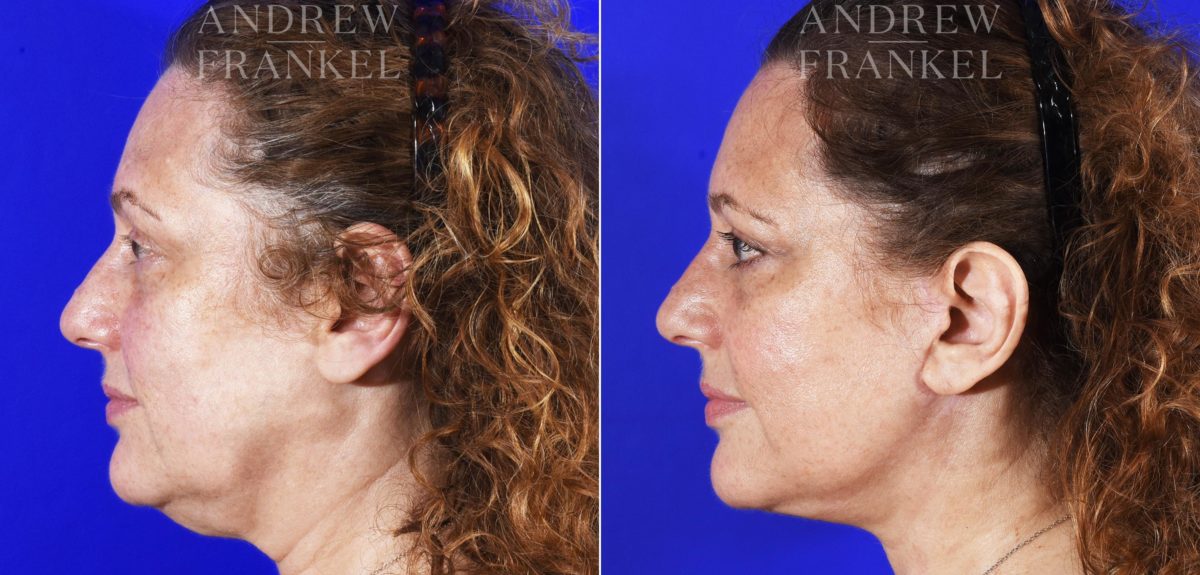 Facelift before and after photos in Beverly Hills, CA, Patient 7045