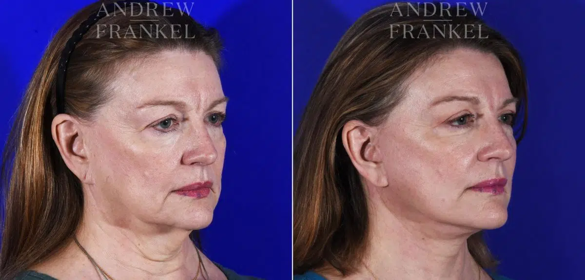 Facial Rejuvenation before and after photos in Beverly Hills, CA, Patient 7065