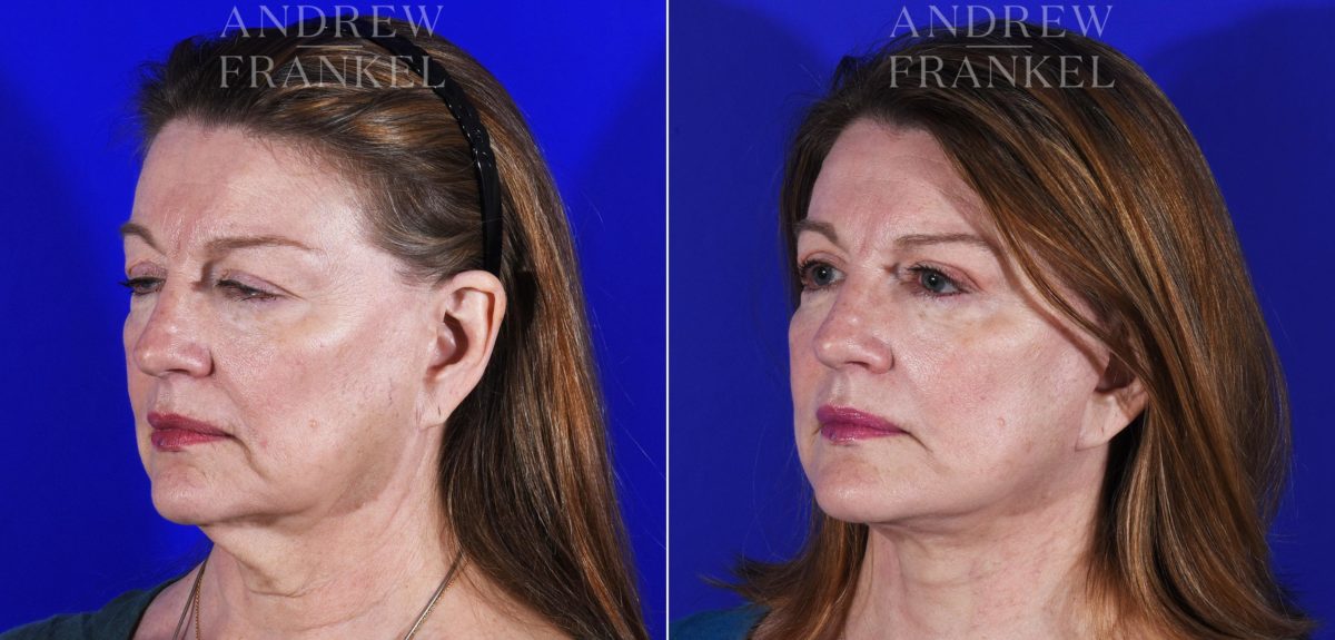 Facial Rejuvenation before and after photos in Beverly Hills, CA, Patient 7065