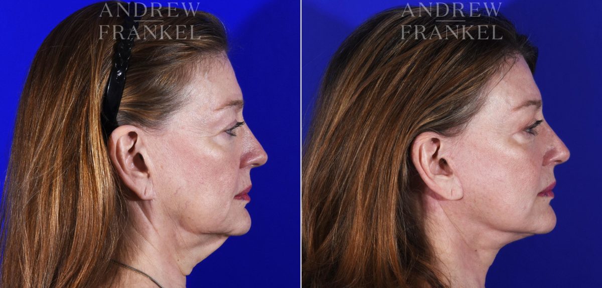 Facial Rejuvenation before and after photos in Beverly Hills, CA, Patient 7065