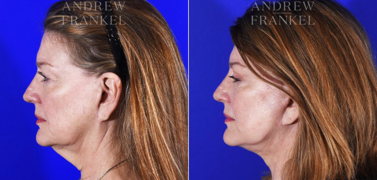 Facial Rejuvenation before and after photos in Beverly Hills, CA, Patient 7065