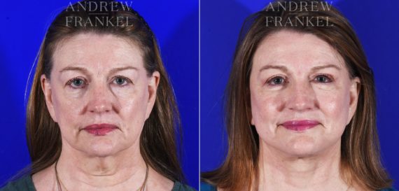 Facial Rejuvenation before and after photos in Beverly Hills, CA, Patient 7065