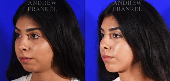 Jawline Contouring before and after photos in Beverly Hills, CA, Patient 7258