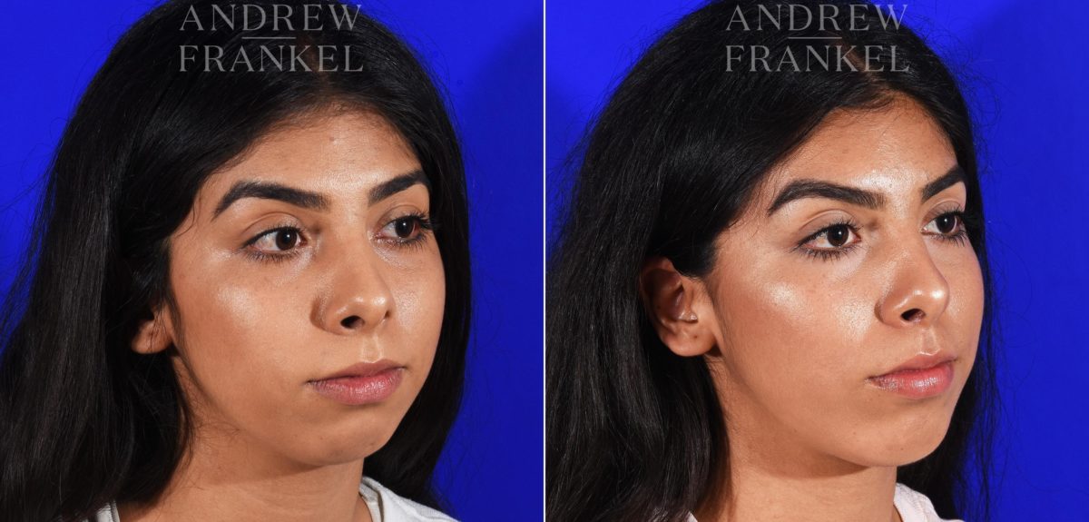 Jawline Contouring before and after photos in Beverly Hills, CA, Patient 7258