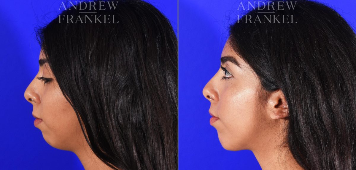 Jawline Contouring before and after photos in Beverly Hills, CA, Patient 7258