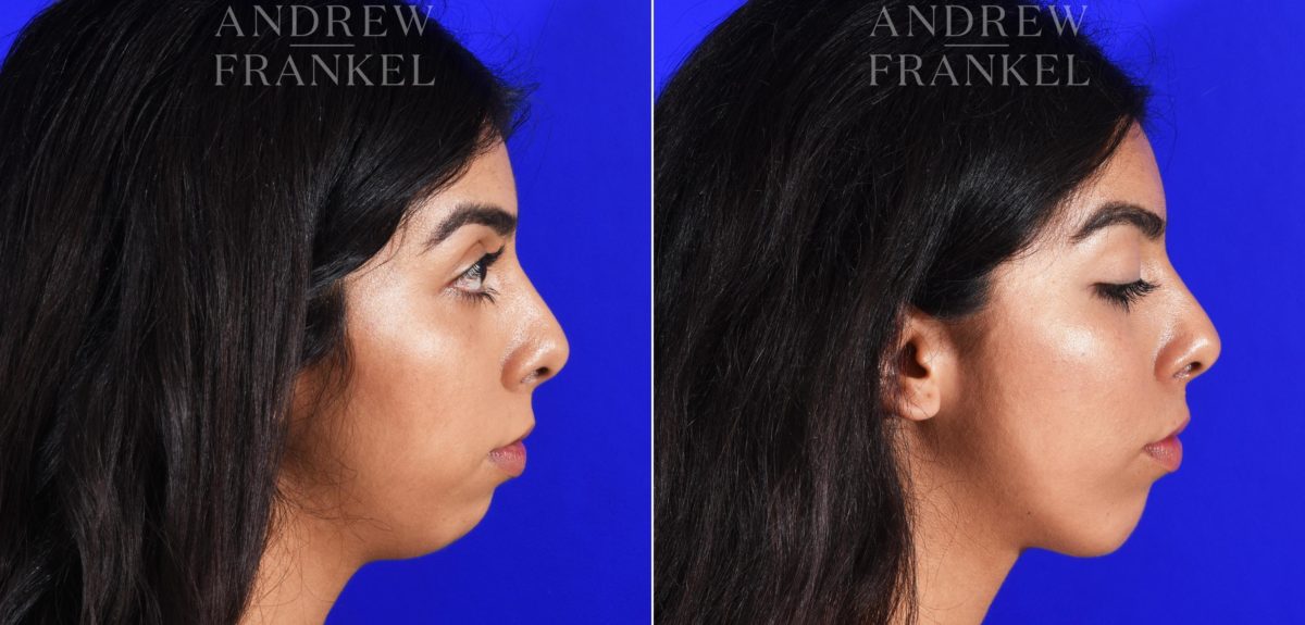 Jawline Contouring before and after photos in Beverly Hills, CA, Patient 7258