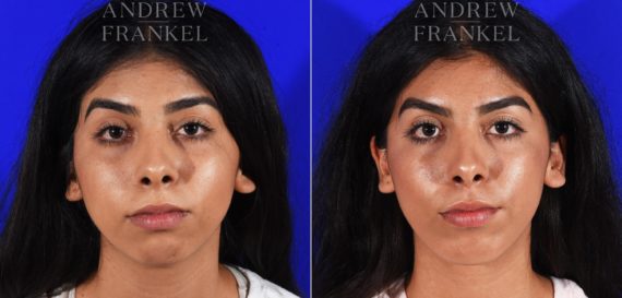 Jawline Contouring before and after photos in Beverly Hills, CA, Patient 7258