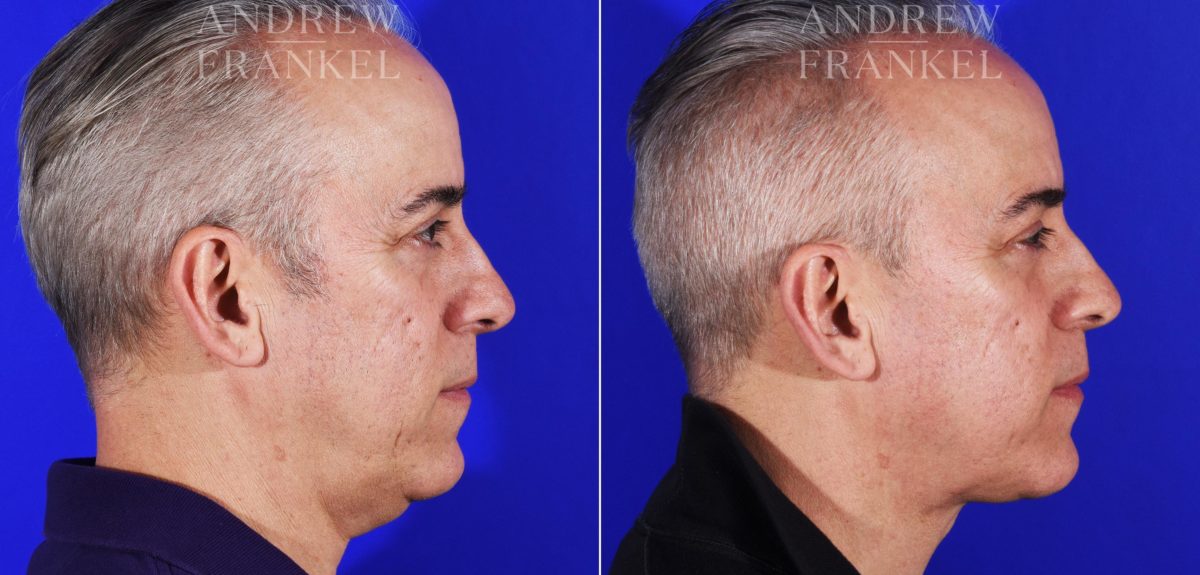 Jawline Contouring before and after photos in Beverly Hills, CA, Patient 7289