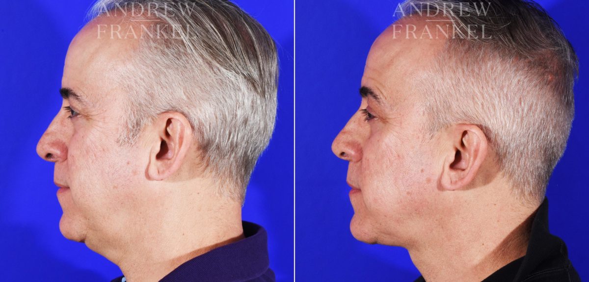 Jawline Contouring before and after photos in Beverly Hills, CA, Patient 7289