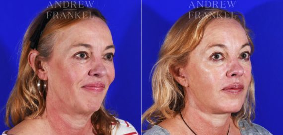Facelift before and after photos in Beverly Hills, CA, Patient 8492