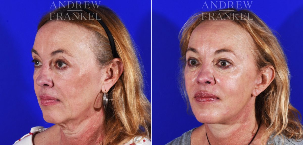 Facelift before and after photos in Beverly Hills, CA, Patient 8492
